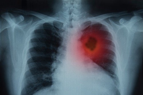 Lung Cancer Diagnosis